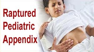 Appendicectomy for Appendicitis in child - Pediatric Appendix