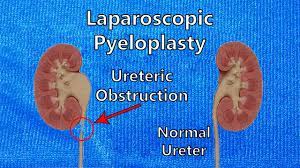 Laparoscopic Pyeloplasty at World Laparoscopy Hosoital