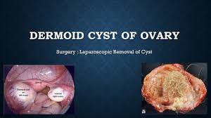 Laparoscopic Cholecystectomy Fully Explained Skin-to-Skin Video with Near Infrared Cholangiography