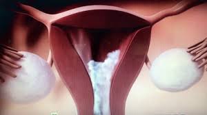 Diagnosis of intestinal endometriosis by laparoscopic surgery