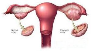 Laparoscopic Ovarian Drilling by Dr. R.K. Mishra