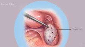 Left Sided Ovarian Cyst Laparoscopic Approach