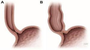 Laparoscopic cardiomyotomy and Dor fundoplication