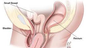 Advanced Precision: Laparoscopic Hernia Repair with Large Sac TAPP Technique