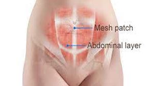 Laparoscopic Repair of Small Umbilical Hernia without Mesh