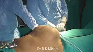Dr. R.K. Mishra showing Laparoscopic Repair of Incisional Hernia