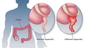 High Definition Laparoscopic Appendicectomy by Two Port