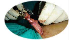 Thoracoscopic Removal of Ectopic Parathyroid Adenoma – by Dr. Piyush Kumar Aggarwal
