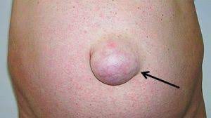 Hysteroscopic Myomectomy - Hysteroscopic Removal of Uterine Fibroids