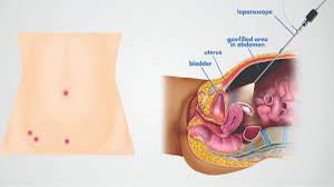 Diagnostic Laparoscopy and Demonstration of Laparoscopic Anatomy