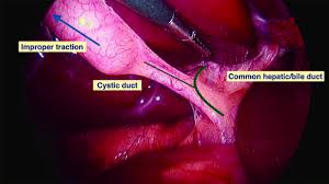 Laparoscopic Cholecystectomy Full Video with Ligation of Cystic Duct