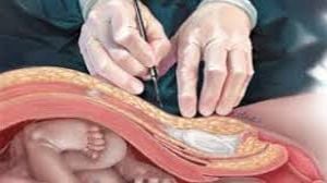 Laparoscopic Surgery for Chronic Ectopic Pregnancy