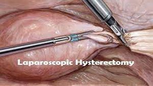 Total Laparoscopic Hysterectomy by Ligation of Uterine artery