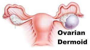 Laparoscopic Salpingo oophorectomy for Huge Ovarian Cyst by Dr. R.K. Mishra