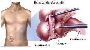 Dr R K Mishra Demonstrating Laparoscopic Appendicectomy