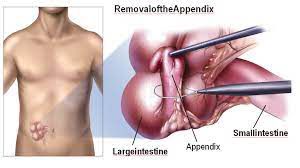 Revolutionizing Hernia Surgery: How Robotics is Enhancing Inguinal Hernia Repair for Patients