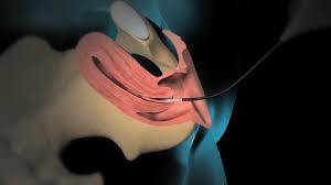 Laparoscopic Repair of Umbilical Hernia