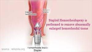 Stapled Hemorrhoidectomy or Minimally Invasive Procedure for Hemorrhoids