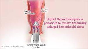 Stapled Hemorrhoidectomy or Minimally Invasive Procedure for Hemorrhoids