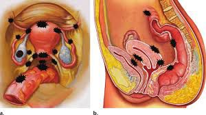 Laparoscopy Mastery: Filling the Gaps in My General Surgery Knowledge Through Training