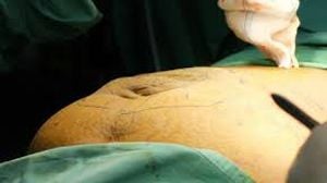 Laparoscopic Repair of Huge Incisional Hernia by Dr. R.K. Mishra