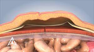 Robotic Nephrectomy by Dr R K Mishra