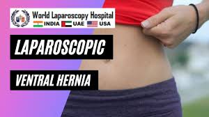 Mini Gastric Bypass Surgery Full Video Skin to Skin by Dr. R.K. Mishra