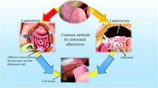 Fibrin Glue for Adhesion Prevension after Laparoscopic Surgery