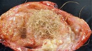 Total laparoscopic hysterectomy (TLH) in patients with previous cesarean section