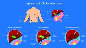 Dr R K Mishra Explaining Laparoscopic Cholecystectomy