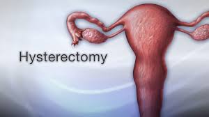 Laparoscopic Hysterectomy TLH by Dr R K Mishra