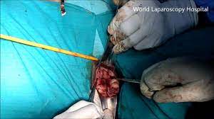 Bisection for Retrieval of uterus after laparoscopic hysterectomy