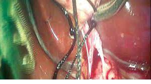 Laparoscopic Cholecystectomy with ligation of cystic duct by Dr R K Mishra