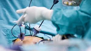 Laparoscopic Cholecystectomy