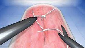 Laparoscopic Anatomy of Pelvis by Dr R K Mishra