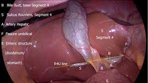 Fundus First Cholecystectomy