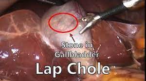 Laparoscopic PCOD Management