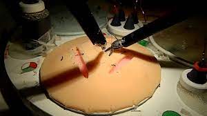 Laparoscopic Repair of Umbilical Hernia by Dr R K Mishra