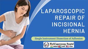 Single Instrument dissection of Laparoscopic Incisional Hernia Repair