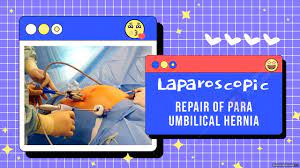 Laparoscopic Repair of Recurrent Para Umbilical Hernia with Ultralene Mesh