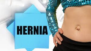 Inguinal Hernia Surgery (TAPP for Indirect Inguinal Hernia)