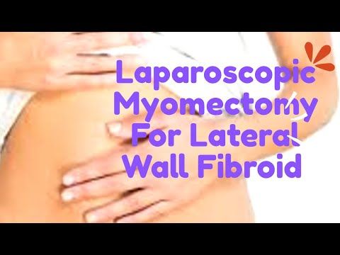 Laparoscopic Myomectomy Lateral Wall Fibroid Uterus