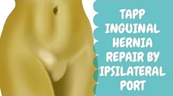 TAPP Inguinal Hernia Repair by Ipsilateral Port