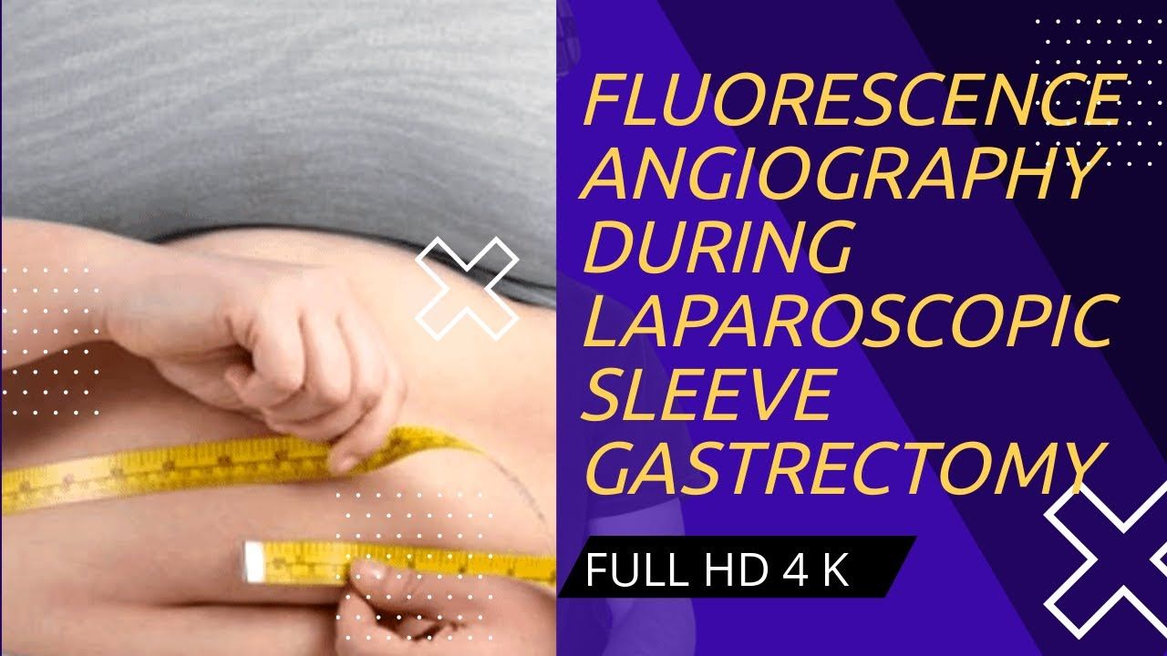 Fluorescence Angiography During Laparoscopic Sleeve Gastrectomy