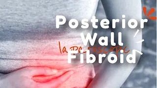 Laparoscopic Management of Posterior Intramural Fibroid