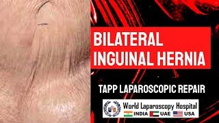 Bilateral Inguinal Hernia Laparoscopic TAPP Repair