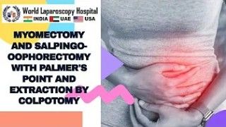 Laparoscopic Myomectomy and Salpingo-oophorectomy with Palmer's Point and Extraction by Colpotomy