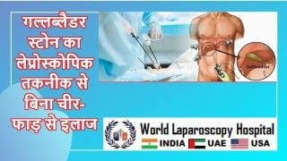 Laparoscopic Ovarian Drilling by Dr. R.K. Mishra