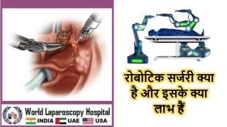 Laparoscopic inguinal hernia repair "IPOM" with Dual-Mesh