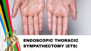 Thoracic Sympathectomy for Hyperhydrosis